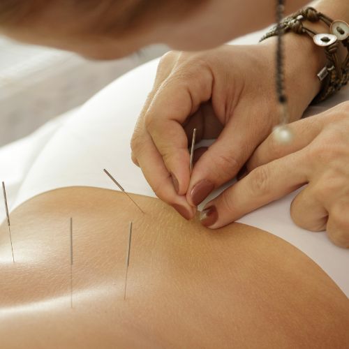acupuncture